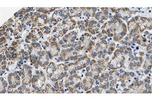 ABIN6274573 at 1/100 staining Human liver cancer tissue by IHC-P. (HTR2C Antikörper  (Internal Region))