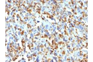 Immunohistochemical staining (Formalin-fixed paraffin-embedded sections) of human histiocytoma with F13A1 monoclonal antibody, clone F13A1/1683 . (F13A1 Antikörper  (AA 46-181))