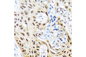 Immunohistochemistry of paraffin-embedded human lung cancer using HES5 Rabbit mAb (ABIN7267559) at dilution of 1:100 (40x lens). (HES5 Antikörper)