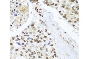 Immunohistochemistry of paraffin-embedded Human lung cancer using BNIP3L Polyclonal Antibody at dilution of 1:100 (40x lens). (BNIP3L/NIX Antikörper)