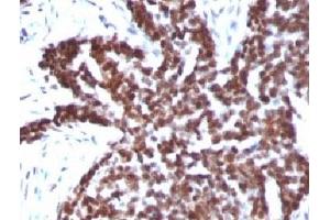 Formalin-fixed, paraffin-embedded human ovarian carcinoma stained with Cyclin B1 antibody. (Cyclin B1 Antikörper)