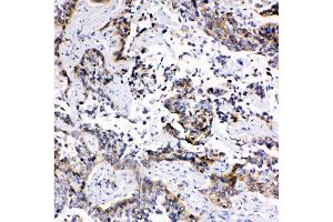 Anti-MRP1 antibody, IHC(P) IHC(P): Human Lung Cancer Tissue (ABCC1 Antikörper  (C-Term))