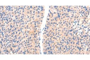 Immunohistochemistry of paraffin-embedded Human liver cancer using PAFAH2 Polyclonal Antibody at dilution of 1:80 (PAFAH2 Antikörper)