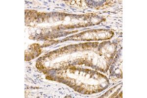 Immunohistochemistry of paraffin-embedded human colon carcinoma using Bag1 Rabbit mAb (ABIN7265847) at dilution of 1:50 (40x lens). (BAG1 Antikörper)