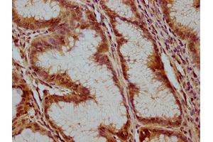 IHC image of ABIN7175232 diluted at 1:100 and staining in paraffin-embedded human gastric cancer performed on a Leica BondTM system. (ATP6V1C1 Antikörper  (AA 129-382))