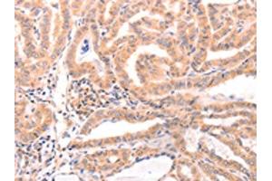The image on the left is immunohistochemistry of paraffin-embedded Human thyroid cancer tissue using ABIN7129152(DAZ4 Antibody) at dilution 1/50, on the right is treated with fusion protein. (DAZ4 Antikörper)