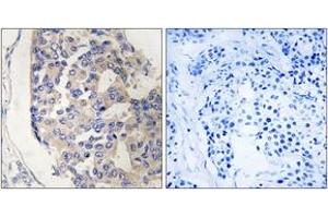Immunohistochemistry analysis of paraffin-embedded human breast carcinoma tissue, using C1S Antibody. (C1S Antikörper  (AA 541-590))