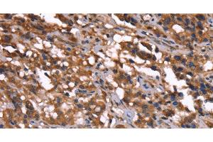 Immunohistochemistry of paraffin-embedded Human thyroid cancer tissue using GREB1 Polyclonal Antibody at dilution 1:40 (GREB1 Antikörper)