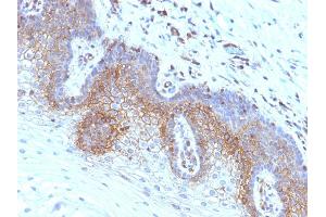 Formalin-fixed, paraffin-embedded human Cervical Carcinoma stained with Beta-2-Microglobulin Monoclonal Antibody (SPM617) (beta-2 Microglobulin Antikörper)