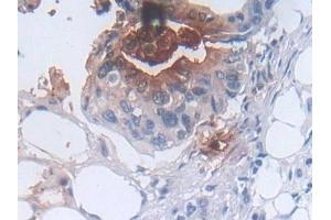 Detection of DEFa3 in Human Colorectal cancer Tissue using Polyclonal Antibody to Defensin Alpha 3, Neutrophil Specific (DEFa3) (DEFa3 Antikörper  (AA 21-94))