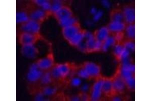 Immunofluorescence analysis of Human liver cancer tissue using CK-16 Monoclonal Antibody at dilution of 1:200. (KRT16 Antikörper)