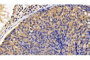 Detection of BLK in Human Breast cancer Tissue using Polyclonal Antibody to B-Lymphoid Tyrosine Kinase (BLK)