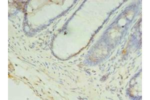 Immunohistochemistry of paraffin-embedded human colon cancer using ABIN7148128 at dilution of 1:100 (CCDC57 Antikörper  (AA 1-300))