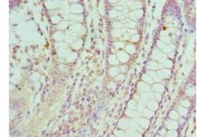 Immunohistochemistry of paraffin-embedded human colon cancer using ABIN7170857 at dilution of 1:100 (SMC1A Antikörper  (AA 1-130))