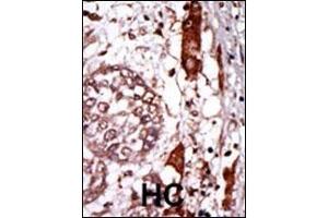 Formalin-fixed and paraffin-embedded human cancer tissue reacted with the primary antibody, which was peroxidase-conjugated to the secondary antibody, followed by AEC staining.