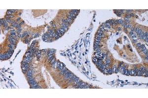 Immunohistochemistry of paraffin-embedded Human colon cancer using CA4 Polyclonal Antibody at dilution of 1:30 (CA4 Antikörper)
