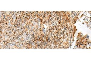 Immunohistochemistry of paraffin-embedded Human cervical cancer tissue using GPR27 Polyclonal Antibody at dilution of 1:25(x200) (GPR27 Antikörper)