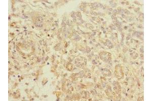 Immunohistochemistry of paraffin-embedded human pancreatic cancer using ABIN7172196 at dilution of 1:100 (TIGD7 Antikörper  (AA 1-300))