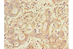 Immunohistochemistry of paraffin-embedded human pancreatic cancer using ABIN7158780 at dilution of 1:100 (CTSA Antikörper  (AA 30-327))