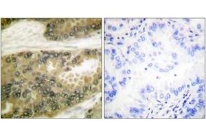 Immunohistochemistry analysis of paraffin-embedded human lung carcinoma tissue, using Cyclin D3 (Ab-283) Antibody. (Cyclin D3 Antikörper  (AA 243-292))