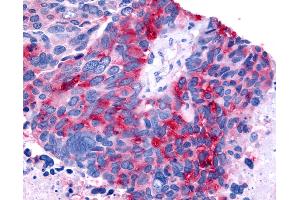 Anti-RORB / ROR Beta antibody IHC of human Lung, Small Cell Carcinoma.