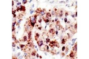 IHC analysis of FFPE human hepatocarcinoma stained with the Ubiquitin antibody (Ubiquitin Antikörper  (AA 36-66))