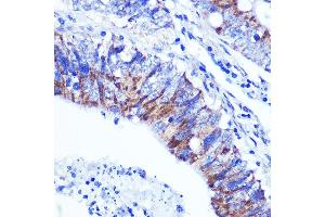 Immunohistochemistry of paraffin-embedded human colon carcinoma using PALLD Rabbit pAb  at dilution of 1:100 (40x lens). (PALLD Antikörper  (AA 383-672))