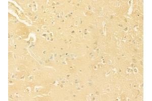 ABIN6263643 and ABIN6277805 at 1/100 staining human glioblastoma by IHC-P.
