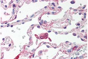 Human Lung, Alveolar Macrophages (formalin-fixed, paraffin-embedded) stained with TLR6 antibody ABIN214529 at 5 ug/ml followed by biotinylated goat anti-rabbit IgG secondary antibody ABIN481713, alkaline phosphatase-streptavidin and chromogen. (TLR6 Antikörper  (Internal Region))