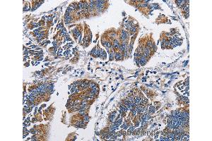 Immunohistochemistry of Human colon cancer using NPPA Polyclonal Antibody at dilution of 1:60 (NPPA Antikörper)