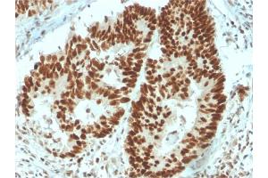 Formalin-fixed, paraffin-embedded human Colon Carcinoma stained with MSH6 Mouse Monoclonal Antibody (MSH6/3091). (MSH6 Antikörper  (AA 374-540))