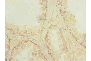 Immunohistochemistry of paraffin-embedded human prostate cancer using ABIN7166868 at dilution of 1:100 (PLPBP Antikörper  (AA 1-275))