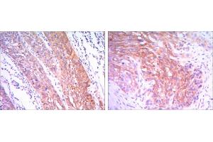 Immunohistochemical analysis of paraffin-embedded esophagus cancer tissues (left) and human lung cancer (right) using HK2 antibody with DAB staining.