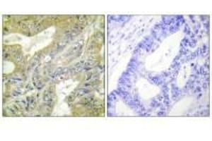 Immunohistochemistry analysis of paraffin-embedded human colon carcinoma tissue using HEXB antibody. (HEXB Antikörper  (C-Term))