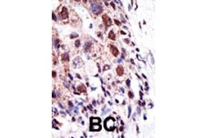 Formalin-fixed and paraffin-embedded human cancer tissue reacted with the primary antibody, which was peroxidase-conjugated to the secondary antibody, followed by AEC staining. (UBE2S Antikörper  (N-Term))