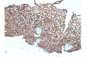 Formalin-fixed, paraffin-embedded human Esophageal Carcinoma stained with Desmoglein-3 Mouse Monoclonal Antibody (DSG3/2840). (Desmoglein 3 Antikörper  (AA 379-491))