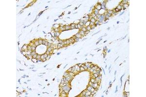 Immunohistochemistry of paraffin-embedded Human breast cancer using VARS Polyclonal Antibody at dilution of 1:100 (40x lens). (VARS Antikörper)