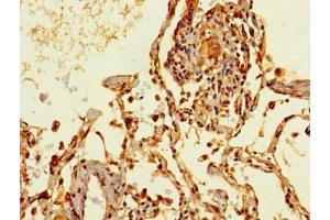 Immunohistochemistry of paraffin-embedded human lung cancer using ABIN7172158 at dilution of 1:100 (THRSP Antikörper  (AA 41-144))
