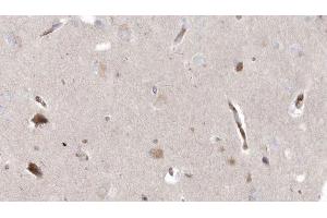 ABIN6272964 at 1/100 staining Human brain cancer tissue by IHC-P. (MPV17 Antikörper  (Internal Region))