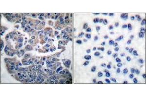 Immunohistochemistry analysis of paraffin-embedded human breast carcinoma, using eEF2K (Phospho-Ser366) Antibody. (EEF2K Antikörper  (pSer366))