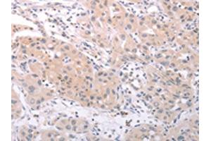 The image on the left is immunohistochemistry of paraffin-embedded Human lung cancer tissue using ABIN7131156(SPATA16 Antibody) at dilution 1/25, on the right is treated with fusion protein.