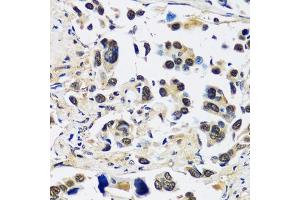 Immunohistochemistry of paraffin-embedded human lung cancer using CCDC59 antibody (ABIN7266440) at dilution of 1:100 (40x lens). (CCDC59 Antikörper  (AA 1-241))