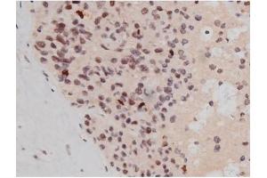 ABIN6267361 at 1/200 staining Human liver cancer tissue sections by IHC-P. (MAPT Antikörper  (pThr181))