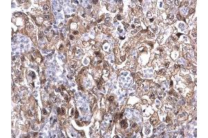 IHC-P Image MAF1 antibody detects MAF1 protein at nucleus on human endometrial carcinoma by immunohistochemical analysis. (MAF1 Antikörper  (Center))