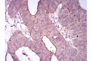 Immunohistochemical analysis of paraffin-embedded rectum cancer tissues using EGFR mutant mouse mAb with DAB staining. (EGFR Mutant (AA 693-893) Antikörper)