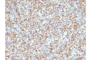 Formalin-fixed, paraffin-embedded human Ewing's sarcoma stained with anti-Vimentin antibody (VM1170). (Vimentin Antikörper)