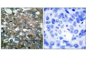 Immunohistochemical analysis of paraffin-embedded human breast carcinoma tissue using (EGFR Antikörper)