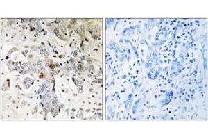 Immunohistochemistry analysis of paraffin-embedded human breast carcinoma tissue, using ZCCHC17 Antibody. (ZCCHC17 Antikörper  (AA 51-100))
