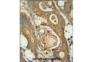 GCNT3 antibody immunohistochemistry analysis in formalin fixed and paraffin embedded human colon carcinoma followed by peroxidase conjugation of the secondary antibody and DAB staining. (GCNT3 Antikörper  (C-Term))