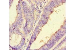 Immunohistochemistry of paraffin-embedded human endometrial cancer using ABIN7162730 at dilution of 1:100 (PDLIM5 Antikörper  (AA 268-404))